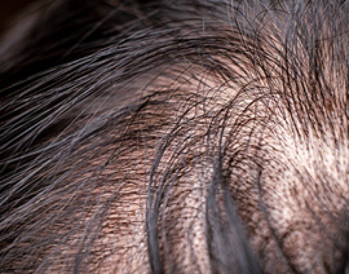 PRP for Hair